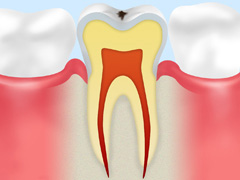 CO（初期の虫歯）