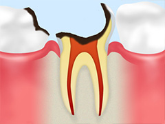 C4（重度の虫歯）