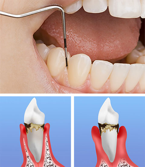 「日本の国民病」とも呼ばれる歯周病の正体とは？