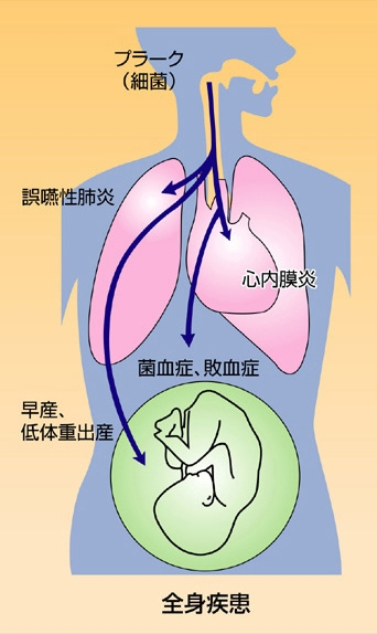 歯周病の危険性